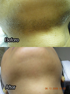 Before-and-after: Chin hair