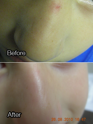 Before and after: Spider angioma