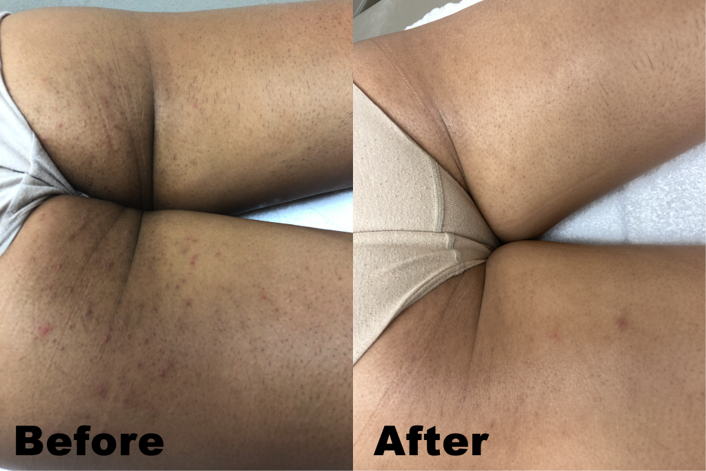 Before-and-after: Hair removal on upper thighs